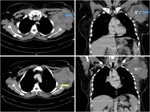 Axial and coronal CT scan of the chest showing a large mass in the left axillary tail of the breast with areas of necrosis (blue arrows) with involvement of anterior chest wall muscles and infiltration of the left subscapularis muscle (yellow arrow).