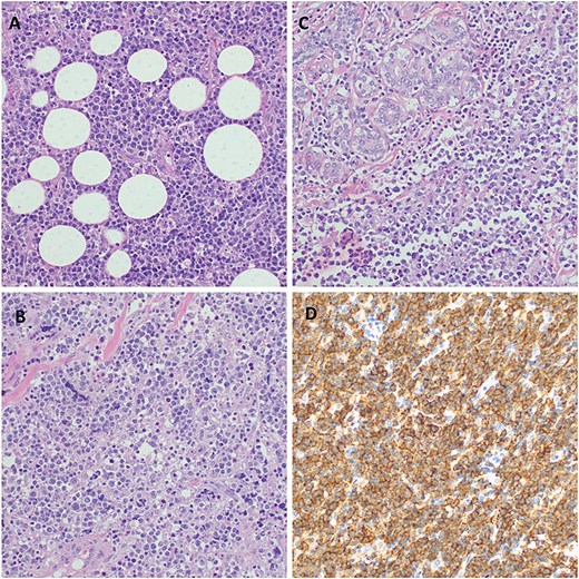 Histopathology of the breast tumor displaying diffuse aggressive high-grade lymphoma characterized by a dense malignant lymphoid infiltrate of fibro-adipose tissue, H&E staining at 40× original magnification (A). Photomicroscopy of the tumor highlighting a population of diffuse large lymphocytic cells that are moderately pleomorphic with scant dense cytoplasm and have enlarged hyperchromatic nuclei, with irregular contours, coarse chromatin, and prominent nucleoli invading the fibrous and skeletal muscles; H&E staining at 100× original magnification (B). Infiltration of the breast tissue by a diffuse large cell lymphoma and surrounding breast parenchyma obliterating mammary gland structures, H&E staining at 100× original magnification (C). Photomicroscopy showing a strong membrane immune-expression of the tumor cells with CD 20; IHC staining a 100× original magnification (D).