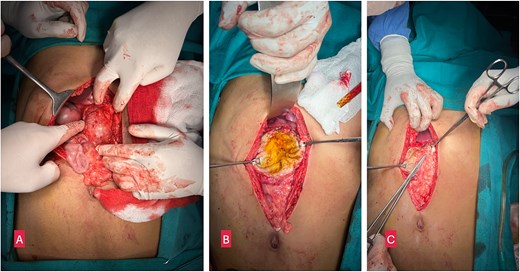 (A) Intraoperative image showing a large cystic lesion in the head of pancreas. (B) Opened up cyst after partial pericystectomy. (C) Omentoplasty.