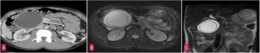 (A) Coronal section of CECT abdomen showing a thick walled, well defined round to oval cystic lesion ~7.5 × 8 × 10 cm in the head and uncinate process of pancreas. (B) Coronal section of MRI-magnetic retrograde cholangio-pancreatography (MRCP) abdomen showing a well defined thick walled cystic lesion in the head and uncinate process of the pancreas with undulating membrane noted within the cyst. (C) Saggital section of MRI-MRCP abdomen with similar findings as above.