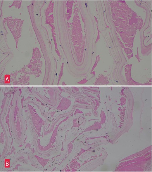 (A) Hemotoxylin and eosin ×10: Section shows lamellated appearance of hydatid cyst. (B) Hemotoxylin and eosin ×40: Section shows lamellated appearance of hydatid cyst.