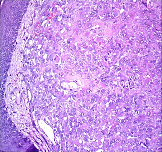 HE ×20: A diffuse poorly differentiated neoplasm composed of pleomorphic epithelioid cells.