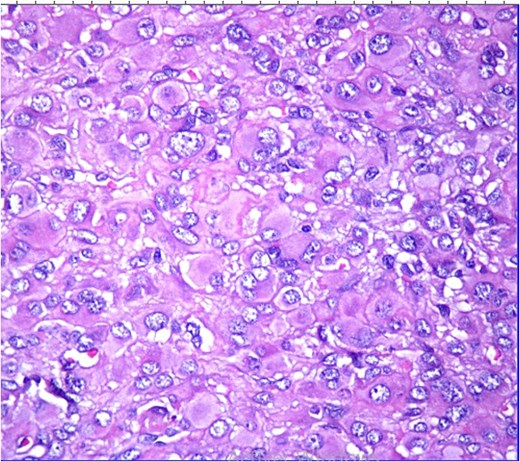 HE ×40: The tumor cells are epithelioid with atypical nuclei.
