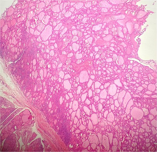 HE × 4: Thyroid follicular adenoma.