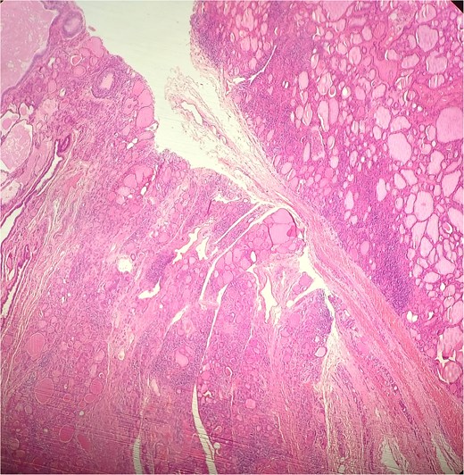 HE × 4 incidental finding of cystic duct structure in the adjacent thyroid gland tissue.