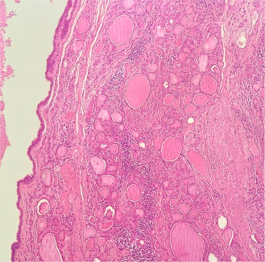 HE × 20: The cyst was lining with pseudostratified ciliated columnar cells and circumscribed with thyroid follicle within the cystic wall.