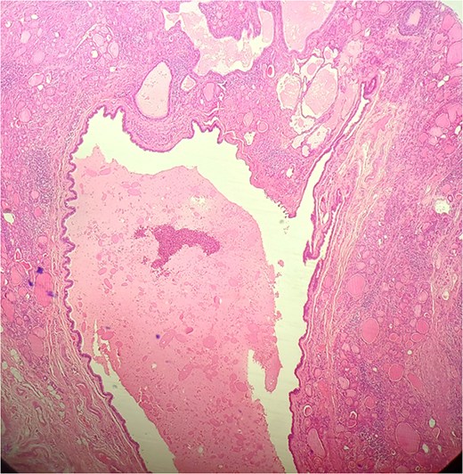 HE × 10: Intra-thyroid ductal cyst with eosinophilic material.