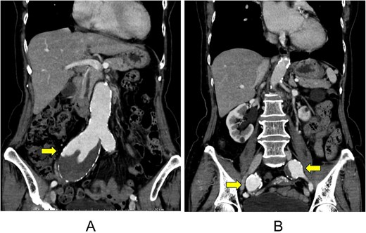Computed tomography images of an abdominal aortic aneurysm (A) and multiple aneurysms of the right and left common iliac arteries (B).