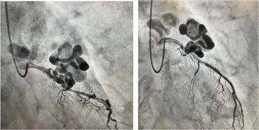Coronary angiography findings of a large CAA originating from the left anterior descending artery.