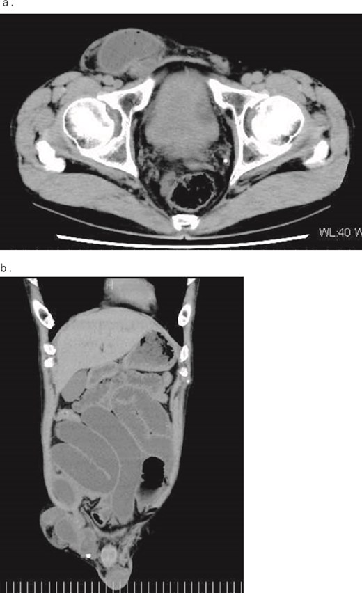 (a) Axial and (b) coronal contrast-enhanced CT images. The images show dilation of the intestine due to incarceration of a right inguinal hernia.