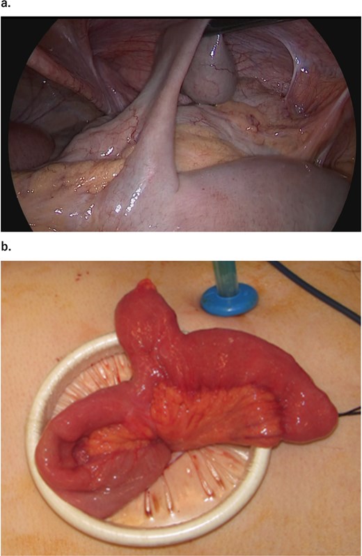Intraoperative image. (a) Intraperitoneal observation reveals a Meckel’s diverticulum 70 cm from the Bauhin’s valve. (b) The intestinal caliber change is observed before and after the Meckel’s diverticulum.