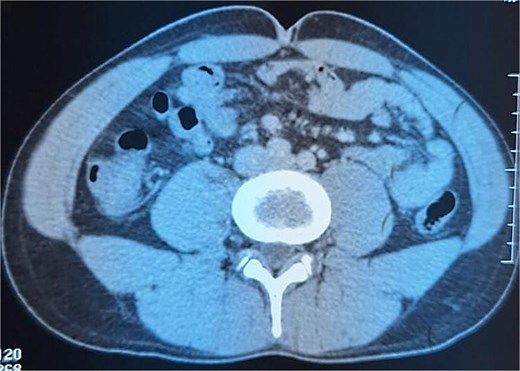 Intraperitoneal mass located in the right iliac fossa, containing calcifications.