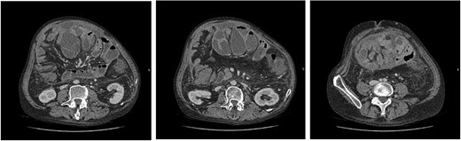 (left to right–cranial to caudal) Axial contrast-enhanced CT images demonstrating dilated small bowel loops in the central abdomen, encapsulated in thickened peritoneum and with trace free fluid. Appearances are consistent with small bowel obstruction.
