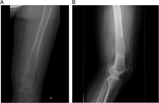 (A and B) Initial radiographs of the distal femur lesion.