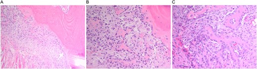 (A–C). Histopathologic images from biopsy specimen at 100× and 200× magnification, showing numerous multinucleated giant cells and mononuclear stromal cells with marked resorption of bone trabeculae and clustering of osteoclasts.