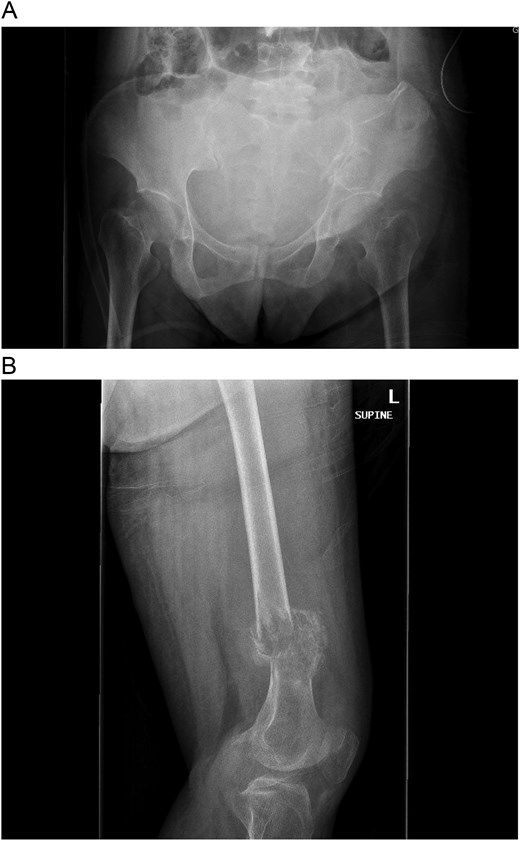 (A and B) Pathologic fracture involving the left distal femur and left iliac bone.