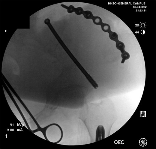 Intraoperative fluoroscopy from ORIF of the pelvis.