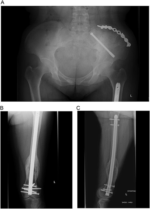 (A–C) Final radiographs showing complete healing >1 year postoperatively.
