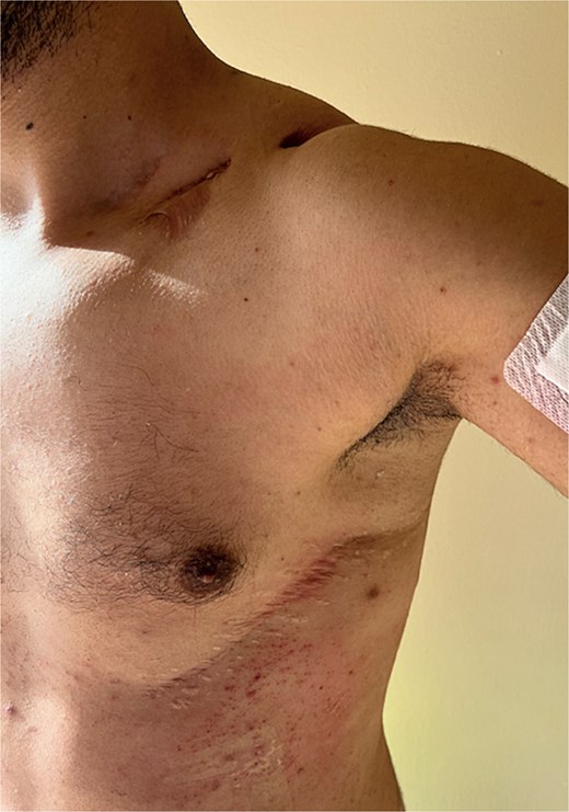 The ancient stab wound which caused a hemothorax and needed an urgent thoracotomy.