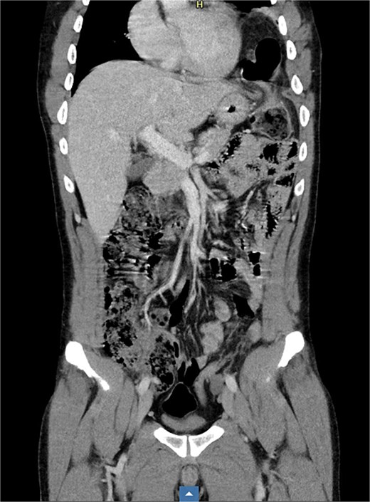 Coronal CT-scan, which shows the diaphragmatic hernia.