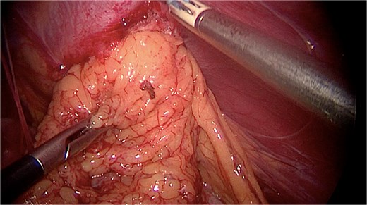 Omentum herniated in the diaphragmatic defect.