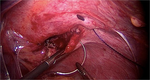 Suturing the diaphragmatic defect.