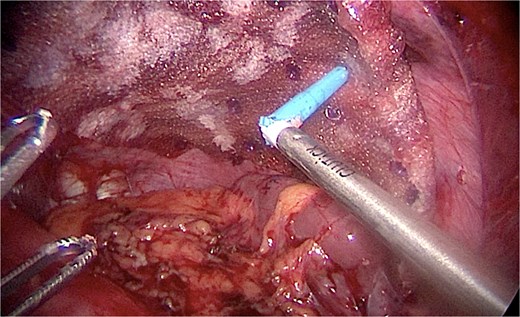 Positioning of the mesh.