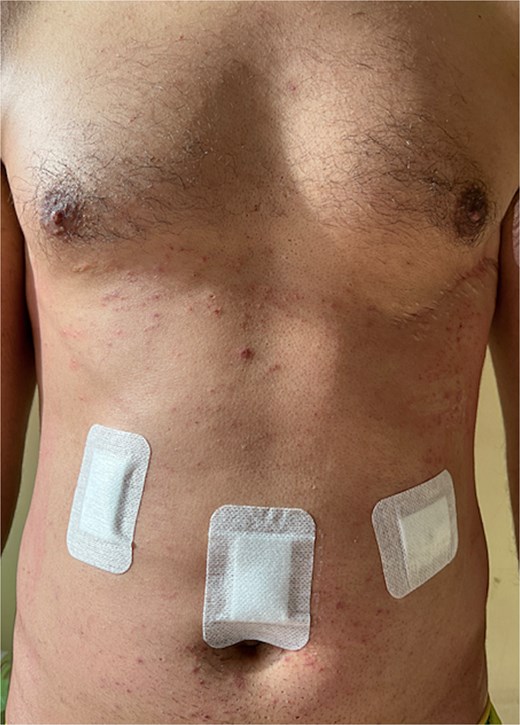 Patients discharging with signs of a three-port laparoscopy.