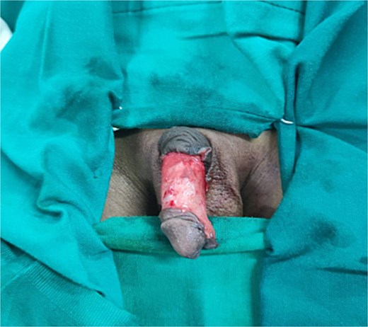 An image showing a circumferential incision a few millimeters proximal to the coronal sulcus with degloved penile skin up to the penile base.