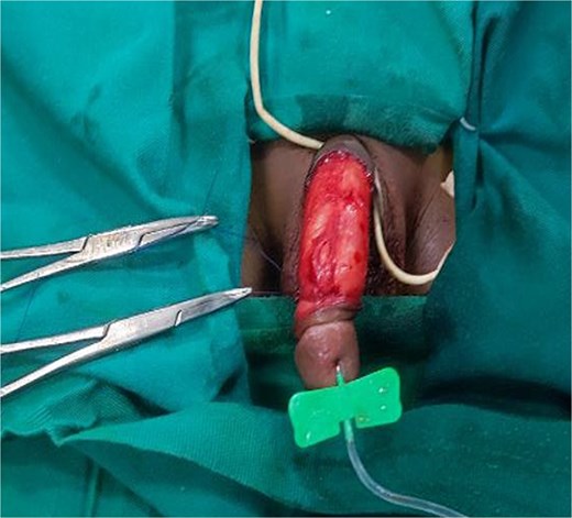 Artificial penile erection using a butterfly needle to assess the correction of the torsion by penile skin degloving.