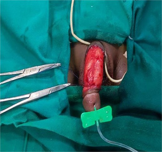 Rotated flap around the penis against the direction of penile torsion then sutured to the ventral aspect of the shaft of the corpus cavernosum.