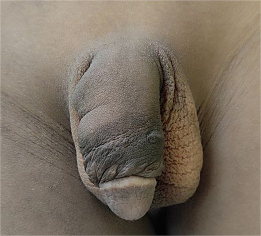 An image at six-month postoperation showing a healed and corrected congenital penile torsion.