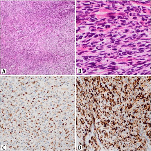 Sections of the testicular mass revealed proliferation of spindle cells that arranged in fascicles (H&E, 10×). These cells exhibit variable degree of nuclear pleomorphism with tumor necrosis and high mitotic activity (H&E, 10×) (A). Numerous rhabdomyoblasts are also present (H&E, 40×) (B). The tumor cells are positive for myogenin immunostain (20×) (C). The tumor cells are positive for desmin immunostain (20×)(D).