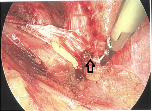 Laparoscopic view of the excised colocutaneous fistula (arrow). The descending colon has been retracted medially.