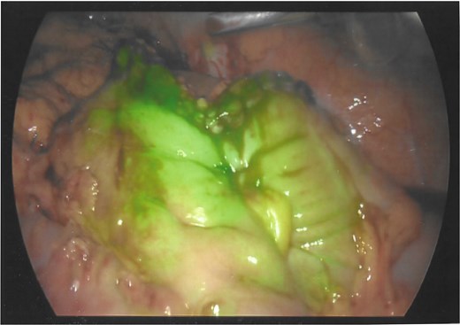 Indocyanide green (ICG) angiography demonstrating good perfusion at the colo-colonic anastomosis.