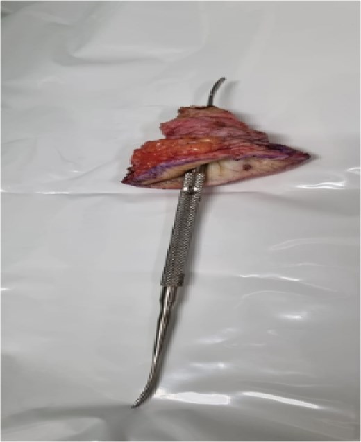 Excised back fistula with tract illustrated with probe.
