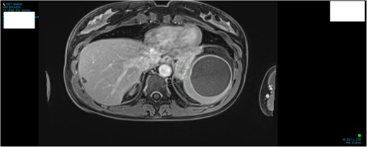 MRI demonstrating anatomical location and size of lesion sagittal plane.