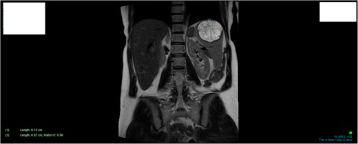 MRI demonstrating size and anatomical location of splenic lesion coronal plane.
