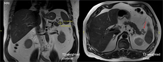 Initial MRI demonstrating a 20 × 26 × 20 mm mixed solid and cystic lesion in the pancreatic tail.