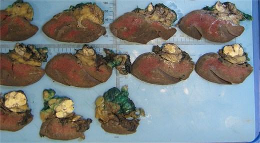 Macroscopic analysis of the operative specimen demonstrating a cystic lesion in the tail of the pancreas containing caseous (cheese-like) material.