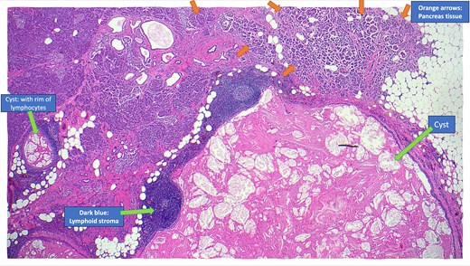 Annotated haematoxylin and eosin-stained microscopic cross-sectional sample demonstrating atrophic pancreatic parenchyma adjacent to the multilocular cyst with benign lymphoid stroma and reactive lymphoid follicles.