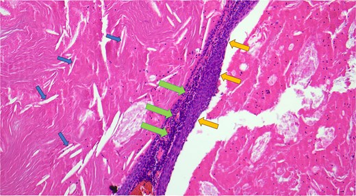 Haematoxylin and eosin-stained microscopic cross-sectional sample demonstrating numerous cholesterol clefts (small left arrows), a band-like rim of lymphocytes (middle large arrows), and the squamous epithelial lining of the cyst wall (medium right arrows).