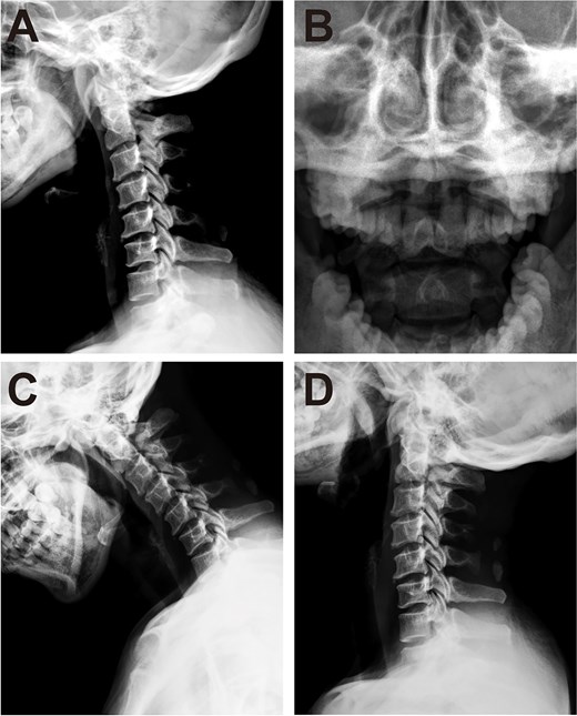 Cervical spine radiograph. (A) Lateral radiograph demonstrating partial aplasia of the posterior arch of the atlas. (B) Open-mouth radiograph showing no atlantoaxial dislocation. (C, D) Cervical spine dynamic X-ray.