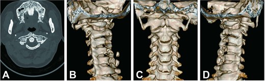 Cervical CT scan. (A) Axial CT image showing hypoplasia of the posterior arch and midline cleft of the anterior arch. (B–D) Three-dimensional reconstructed CT images showing atlas deformity from different views.