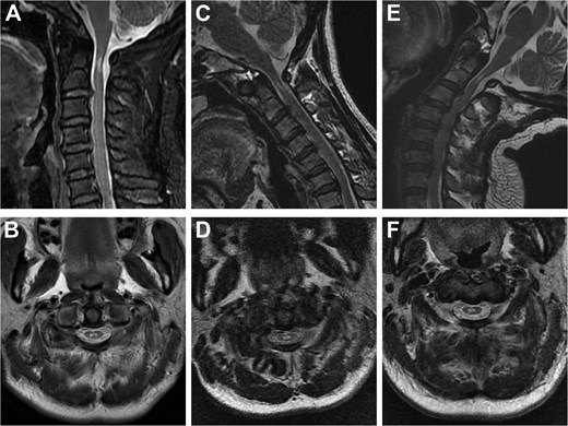 Sagittal and axial T2-weighted MRI of the cervical spine. (A, B) Supine neutral position. (C, D) Supine neck flexion position. (E, F) Supine neck extension position.