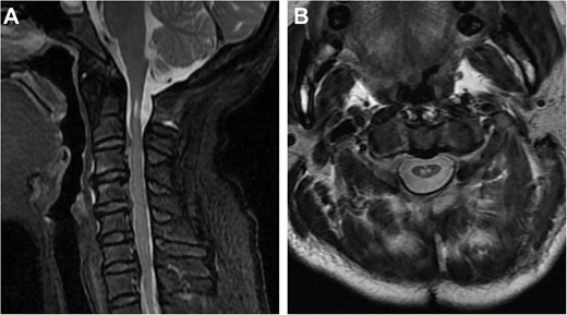 Two-year postoperative MRI results. (A) Sagittal T2-weighted MRI. (B) Axial T2-weighted MRI.