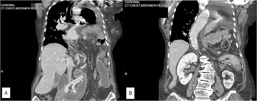 (A) Coronal CT scan showing pleural effusion and large left diaphragmatic herniation including a large portion of small bowel as well as splenic flexure of the colon. (B) Coronal CT scan showing herniation into pleural space with an effusion as well as anterior splenic hypoattenuation representing infarction.
