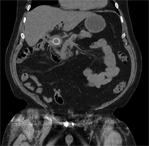 CT of the abdomen without contrast showing a large stone measuring ~3 × 2.1 cm in the proximal duodenum with surrounding induration suggesting a choledochoenteric fistula as indicated by the arrows.