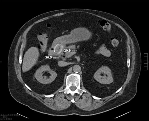 CT of the abdomen without contrast showing biliary gas, suspicious for cholangitis, in addition to the previously mentioned stone.
