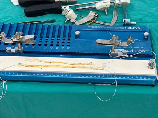 Hamstring allograft with high-strength suture whipstitched at both ends of the graft. The same color of suture is used for each graft for identification of the graft.